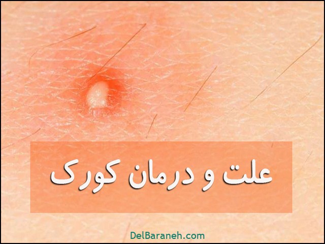 علت و درمان کورک