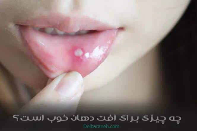 چه چیزی برای آفت دهان خوب است؟